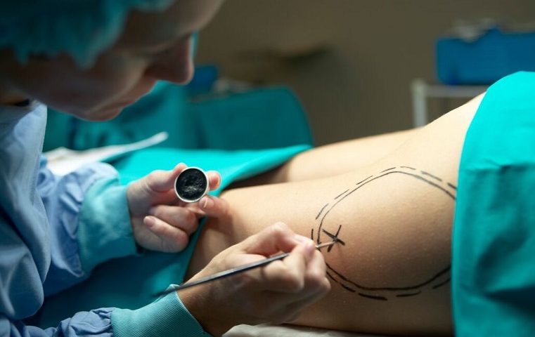 A Comprehensive Guide to Finding the Right Elbow Surgeon