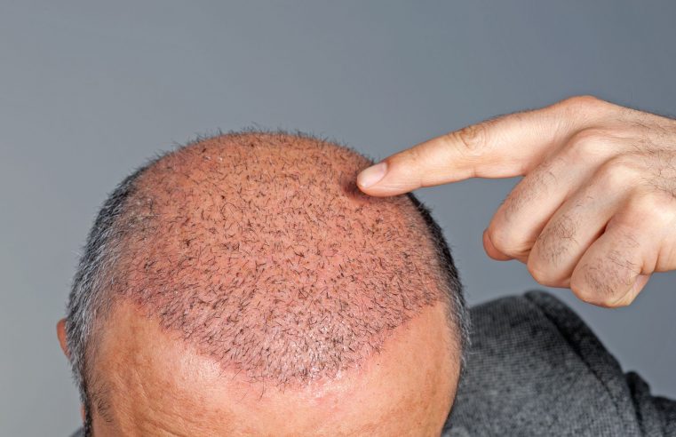 Longevity of the Hair Transplant: Your Options Now