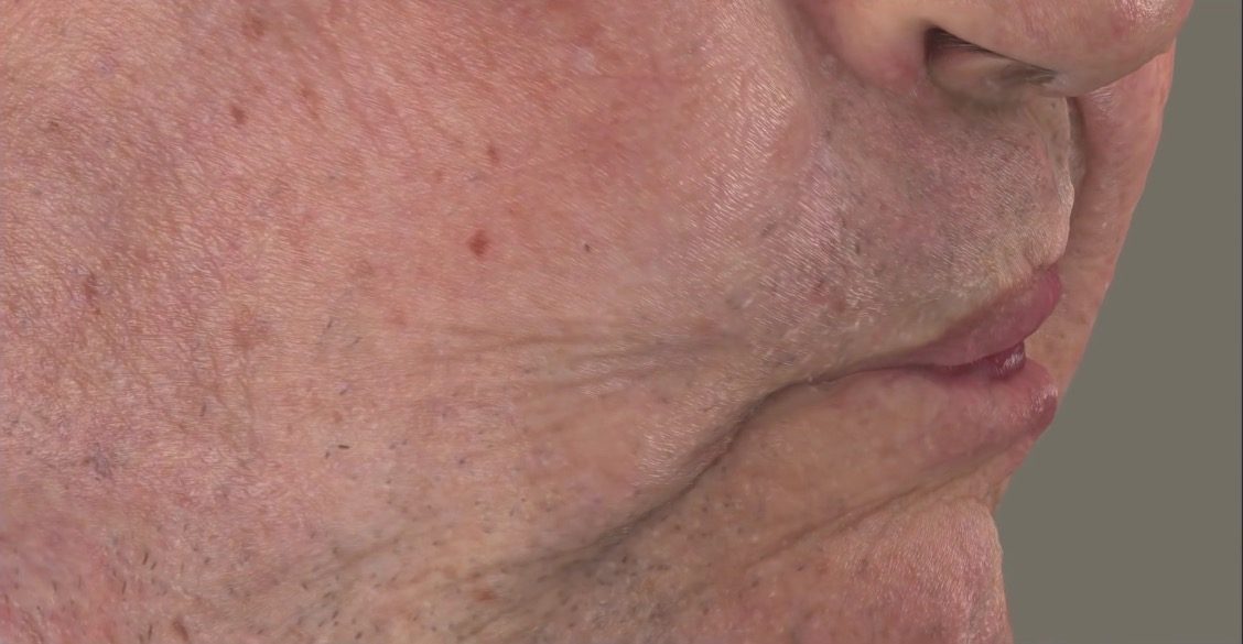 Facial Reconstruction Solution for Skin Deformation