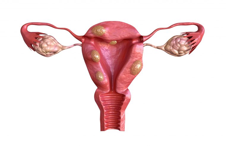 What You Ought to Know About Fibroids Treatment