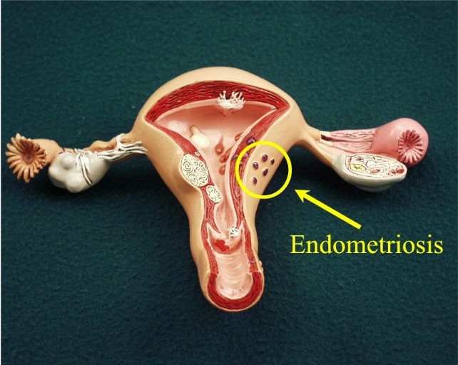 Treatment Options for Endometriosis to Help Enhance Your Quality of Life