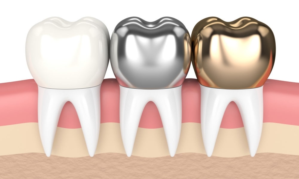 What to Consider When Choosing Dental Crowns