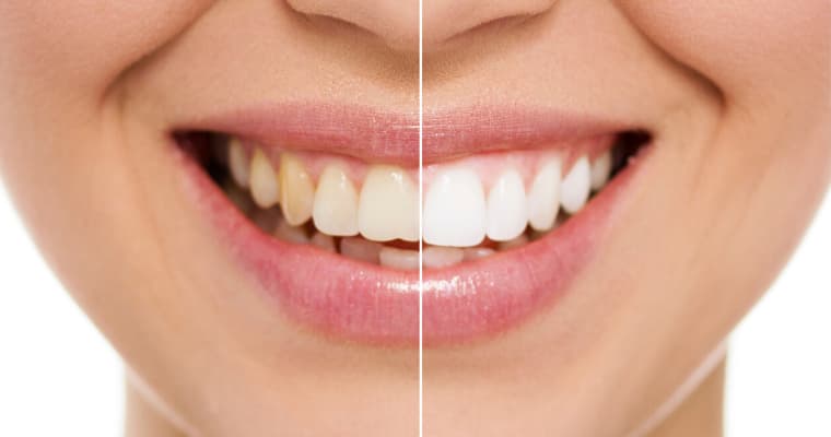 Life-changing Benefits of Teeth Whitening