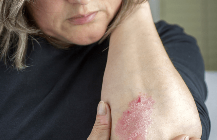 How to cope with psoriasis
