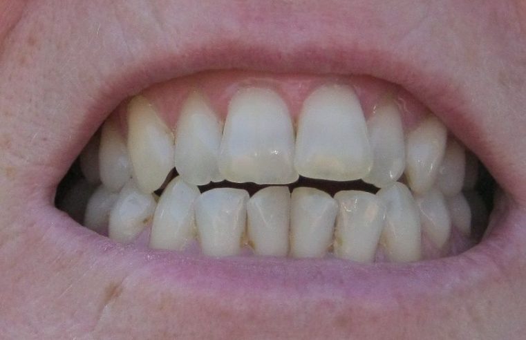 What Happens During Tooth-Colored Enamel Restoration