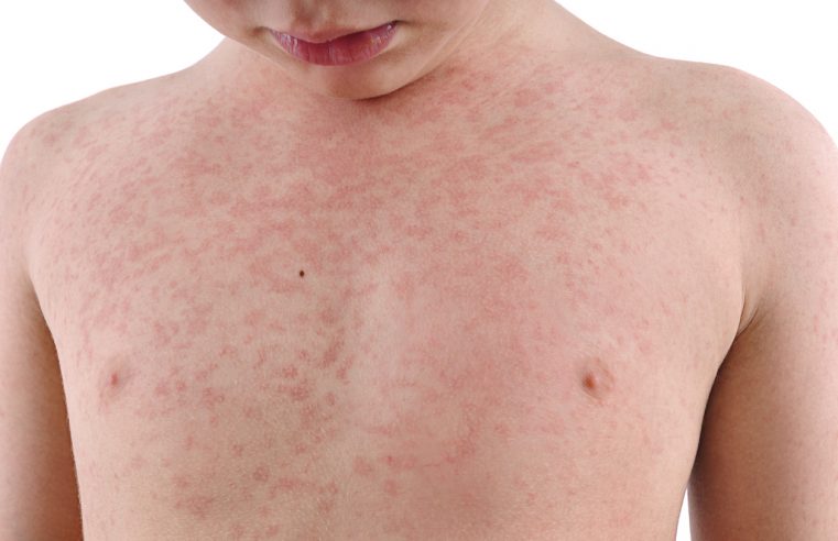 Signs That You Have an Allergic Reaction