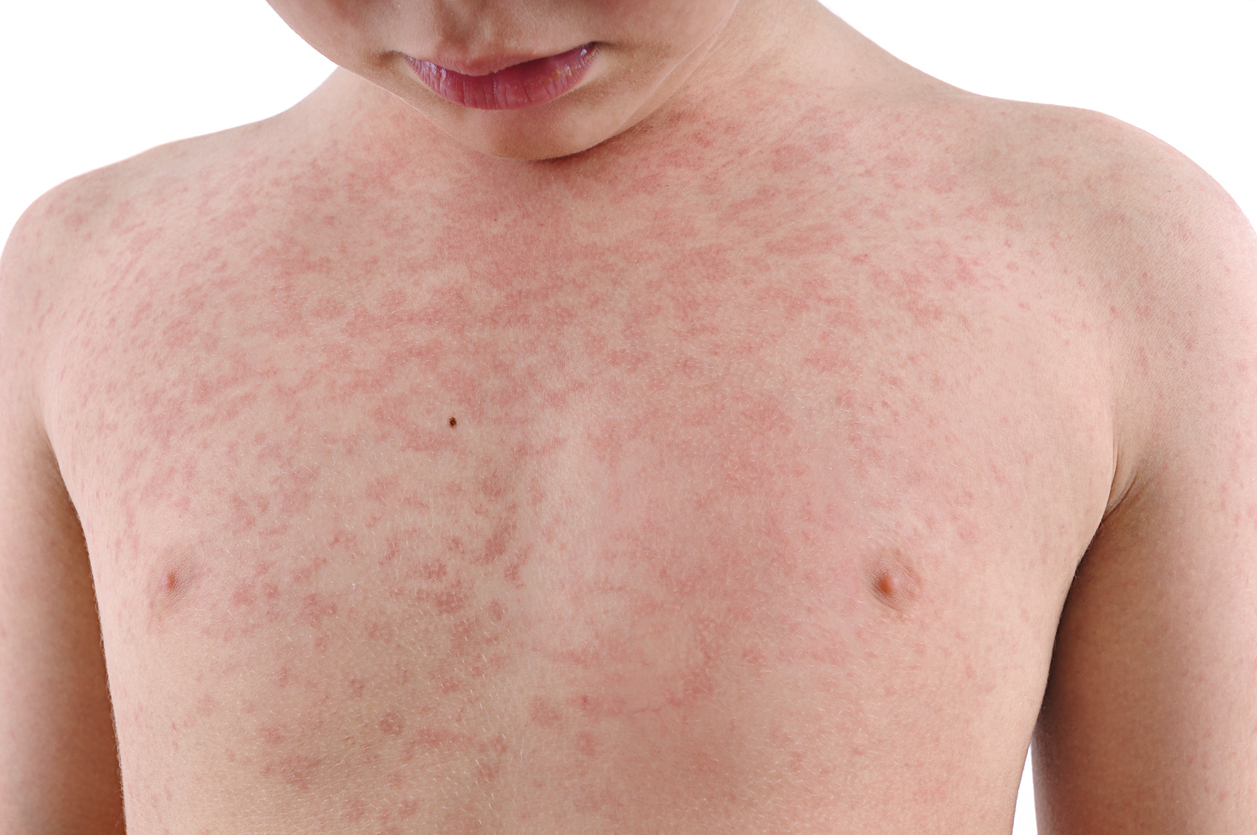 Signs That You Have an Allergic Reaction