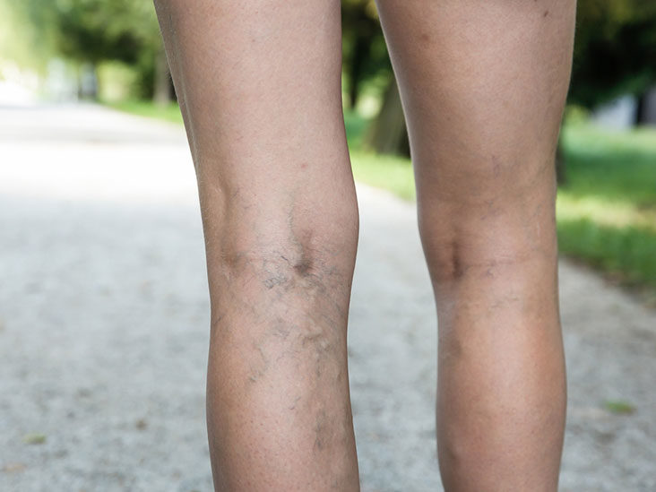 Varicose Veins, What You Need to Know