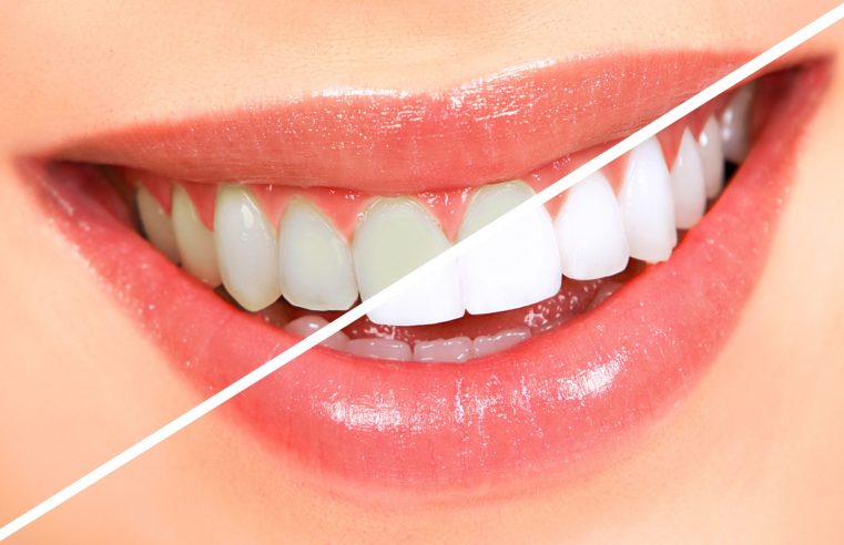Essential Facts You Should Know Before Opting for Teeth Whitening