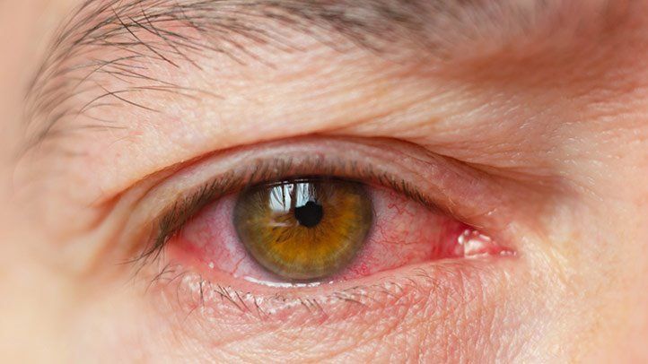 Dry Eye: Everything You Need to Know