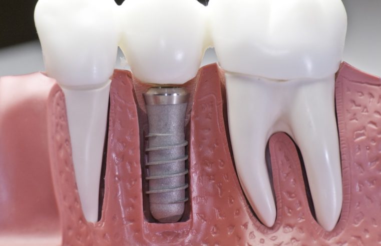 Fill Any Tooth Gaps and Enhance Your Smile with Implant Dentistry in Frisco