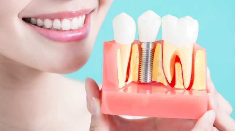 Interested in Getting Dental Implants? Check This Guide!