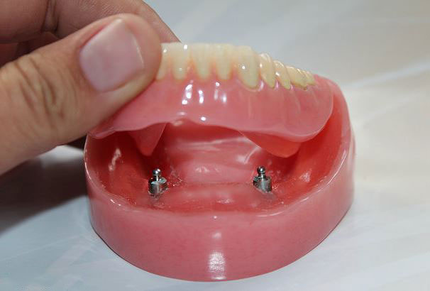Top 5 Reasons to Go for Implant-Supported Dentures