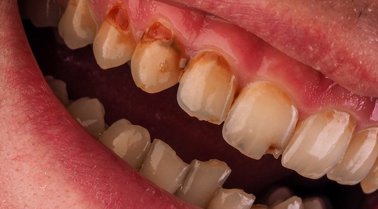 Exceptional Diagnosis and Treatment of Gingivitis in Midtown, NY