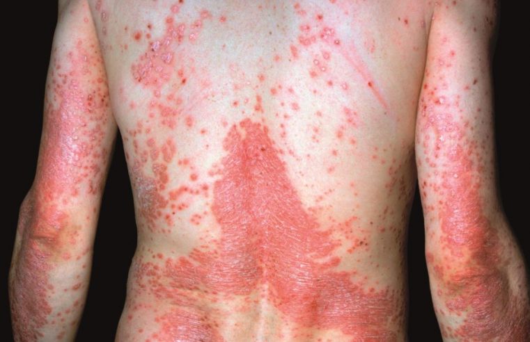 Psoriasis: The disease and its treatment