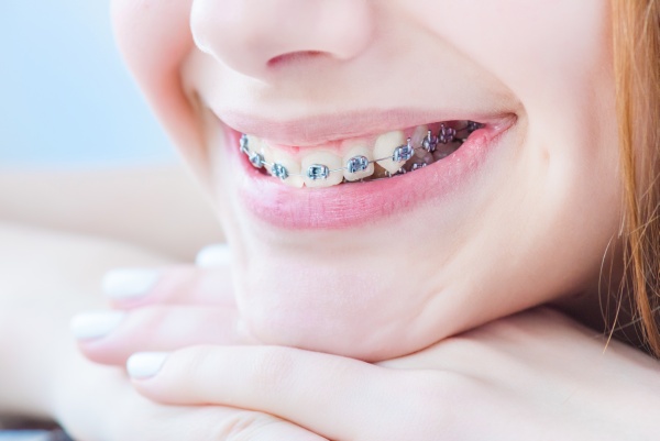 The Fundamentals of Braces: What You Should Know About this Orthodontic Procedure