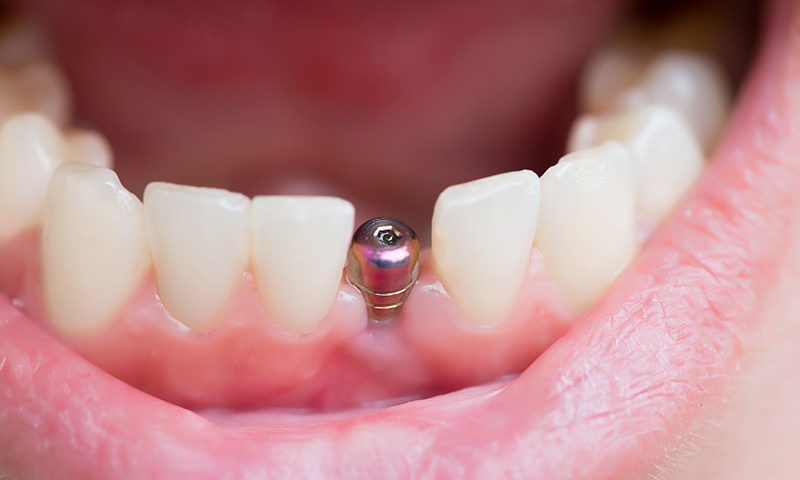Are Dental Implants Ideal for Me?
