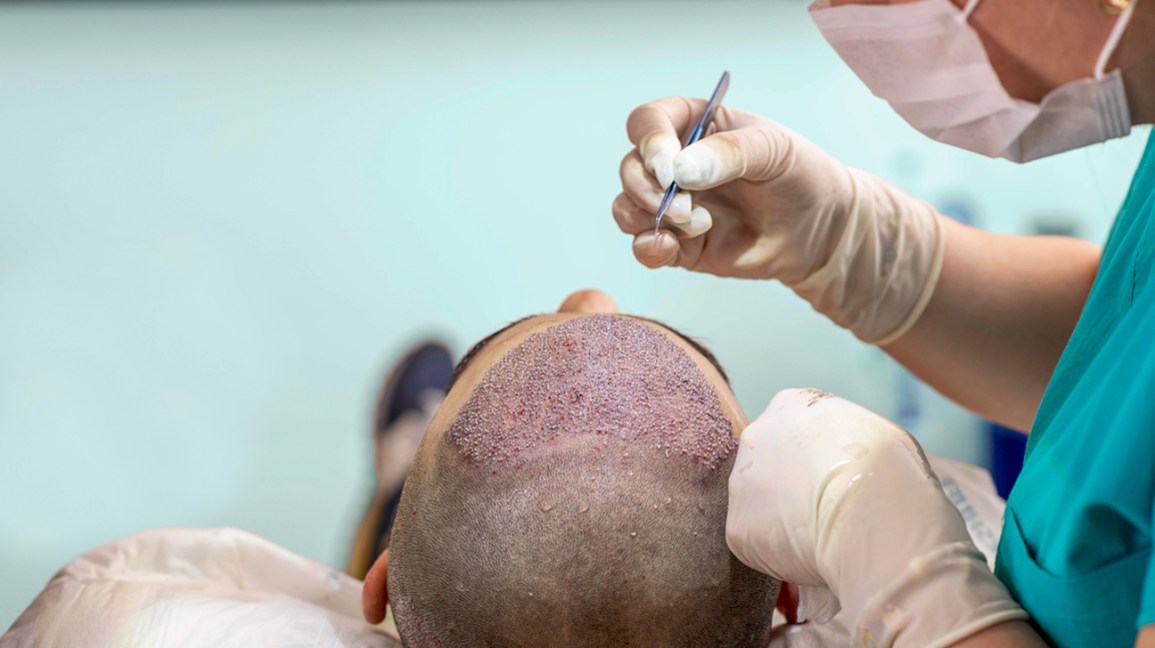 Two Hair Restoration Procedures You Never Knew About