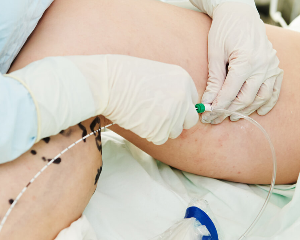 Get The Facts Right About Endovenous Radiofrequency Ablation