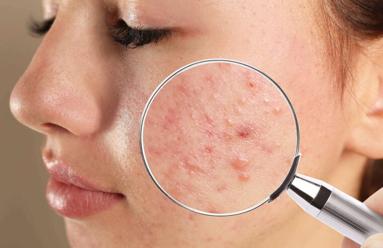 5 Reasons you need an acne treatment at the earliest!