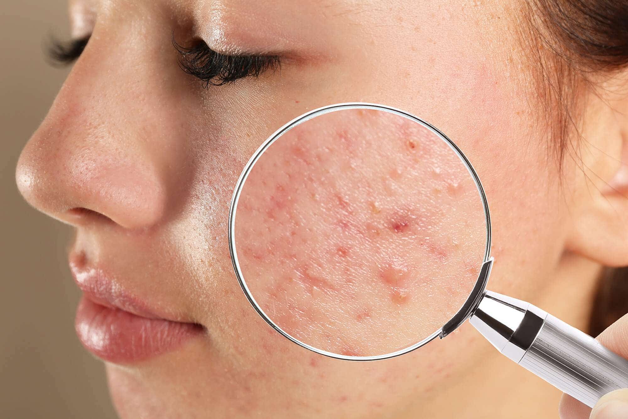 5 Reasons you need an acne treatment at the earliest!